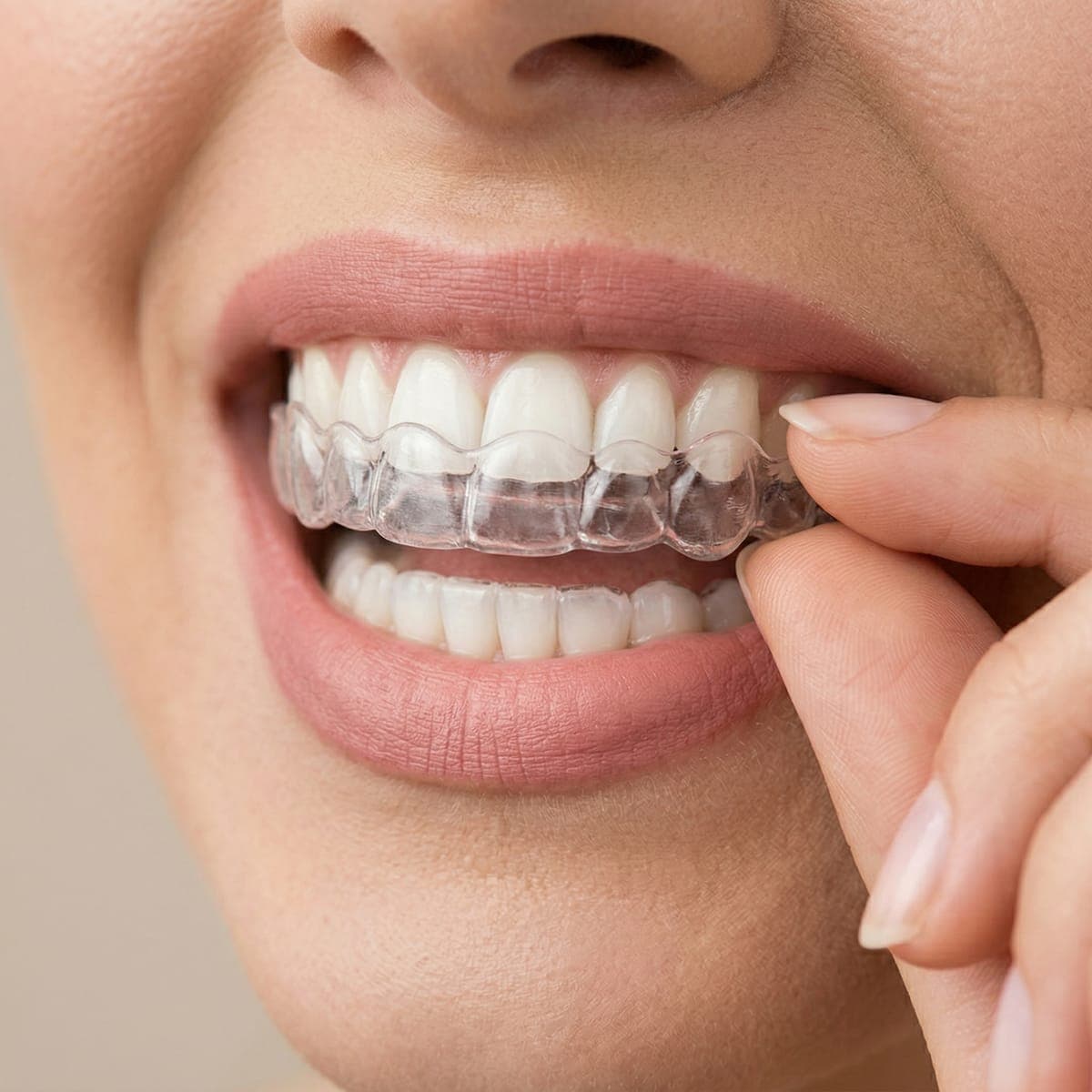 Invisalign
